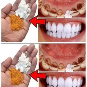 Teeth whitening in just 2 minutes – turning yellow and..