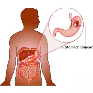 2 / Cᴀɴᴄᴇʀ in the stomach develops silently. These are the first signs! You should be attentive!