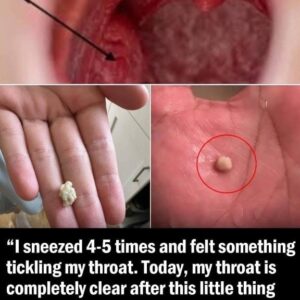 Here’s What You Need To Know About Tonsil Stones – The Weird Pimple-like Growths In Your Throat