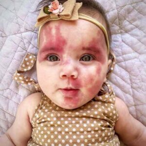 Baby With Red Birthmark Called ‘Hideous’ And ‘Defective’, But Wait till You See This Beautiful Child Now