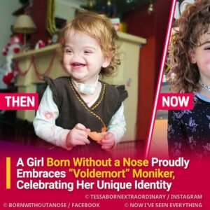 Girl Born Without a Nose Proudly Embraces “Voldemort” Moniker, Celebrating Her Unique Identity