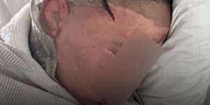 Georgia boy recovering after horrifying sleepover prank