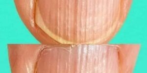 Rippled fingernails reveal secrets of possible disease
