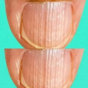 Rippled fingernails reveal secrets of possible disease Rippled fingernails reveal secrets of possible disease